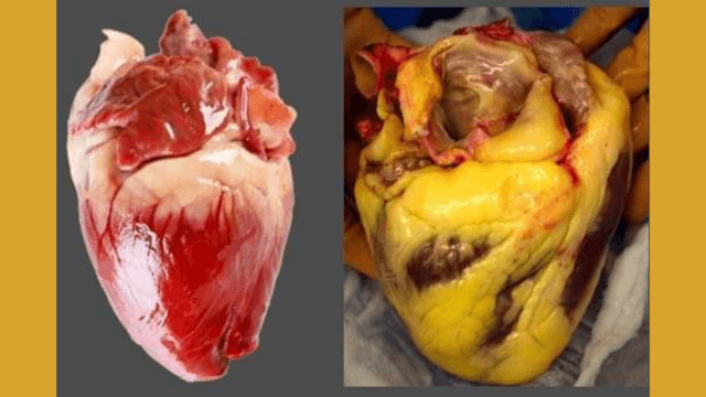 Common Breakfast Foods That Raise Cholesterol: Cutting Them Can Help Your Heart