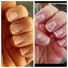 "Growing nails... Beauty or Trouble?"